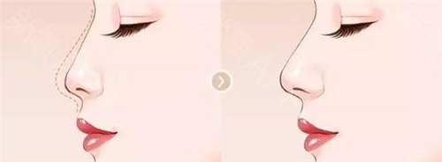 天津伊美尔王牌新品季，美人弧双C隆鼻技术再升级